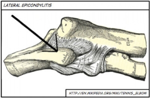 Jak leczyć łokieć tenisisty?