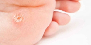 Jak pozbyć się kurzajki?